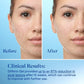 Differin Acne Retinoid Face and Body Treatment Gel Adapalene 0.1% 15g - Imperfect Box