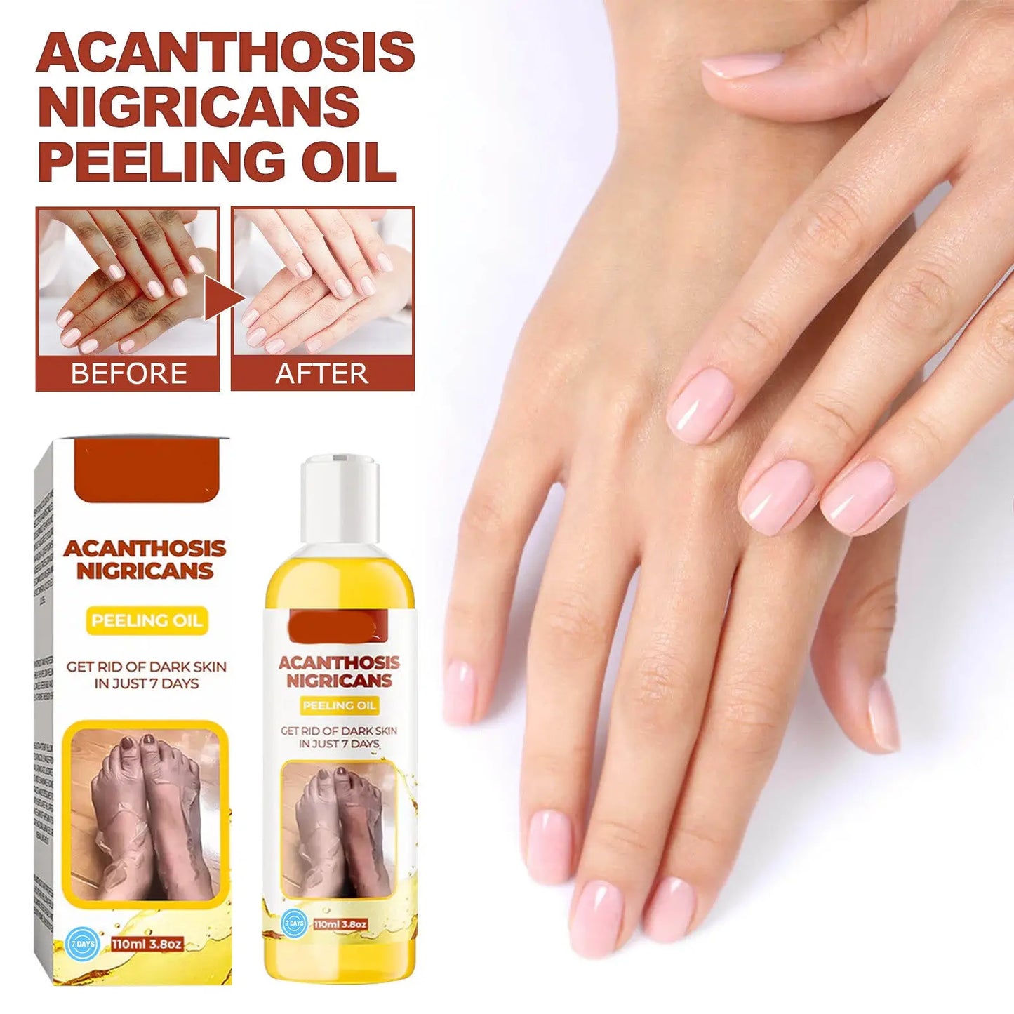 Acanthosis Nigricans Peeling Oil for Dark Spots 110ml