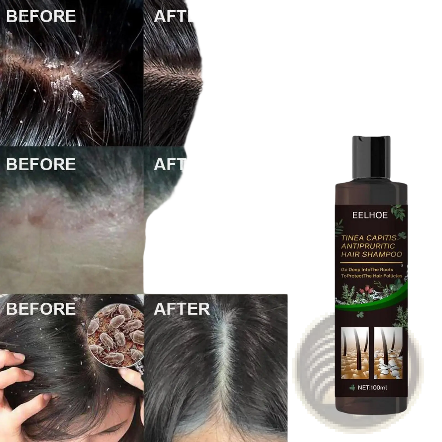 Anti-dandruff Shampoo for Itch Relief and Oil Control